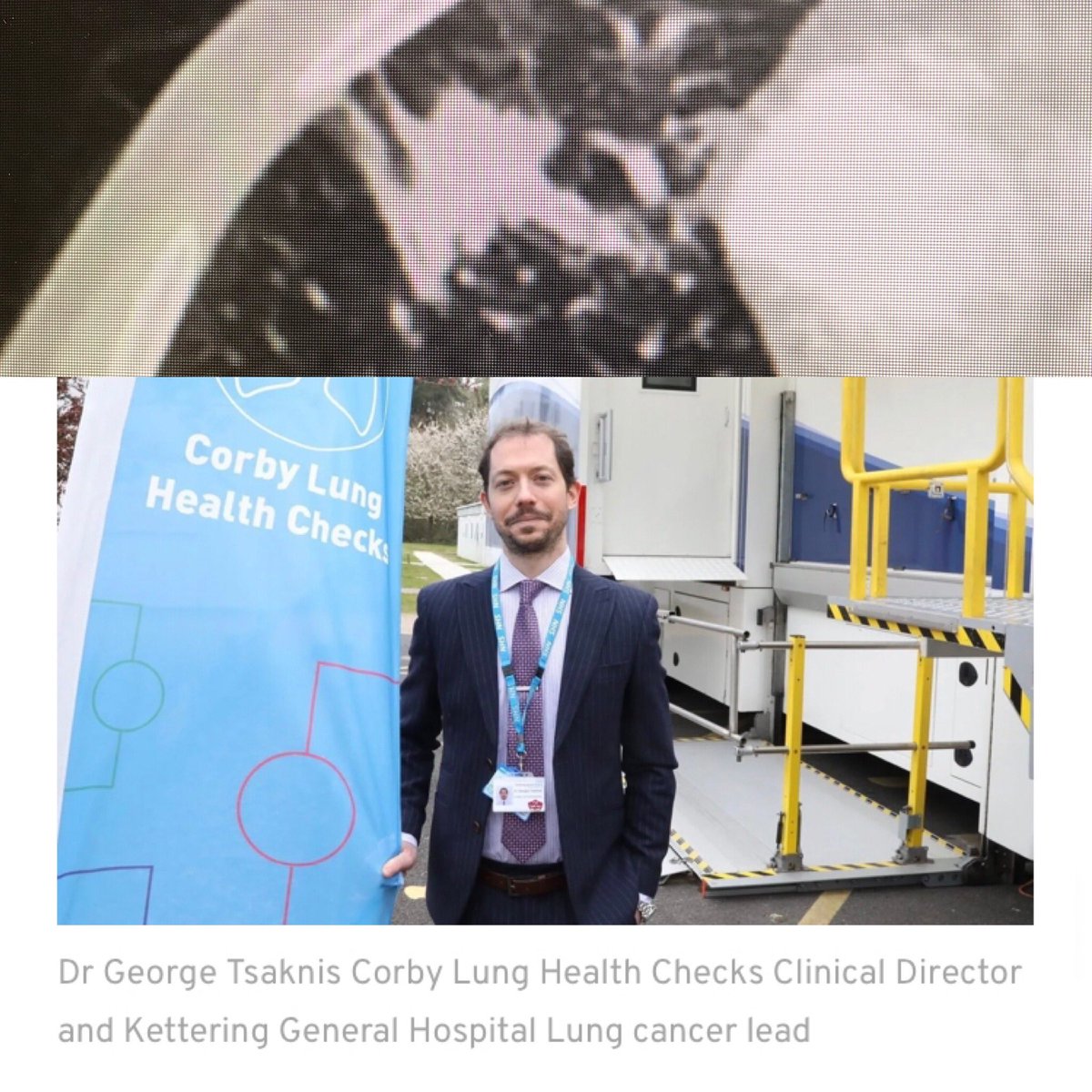 Scanned few hundreds of eligible individuals in our area (aim is ~9,000) and have detected and cured some early lung cancers 🎉
Game-changer for lung cancer mortality. Please attend if offered - it can save your life.
#lungcancerawareness 
#smokingcessation 
<a href="/KettGeneral/">Kettering General Hospital</a>