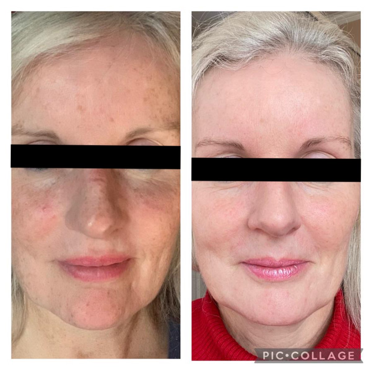 Its time to #glowup this summer with a combo treatment: #ResurFx  + #IPL will tighten and activate cellular rejuvenation! 
Email us at office@skintuition-ltd.co.uk or head to our website at skintuition-ltd.co.uk
#skintuitionltd #healthyskin