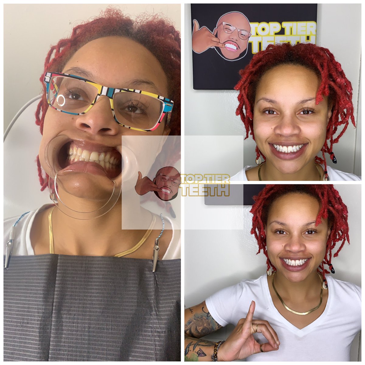 Toptierteeth's tweet photo. While scrolling through her discovery page on Instagram Lauren ran across my business page. Impressed with the results, she instantly booked a teeth whitening session and put it on her schedule to drive down from Jackson, Mississippi. Do you think it was worth the drive? https://t.co/P7bqq4Yjxh