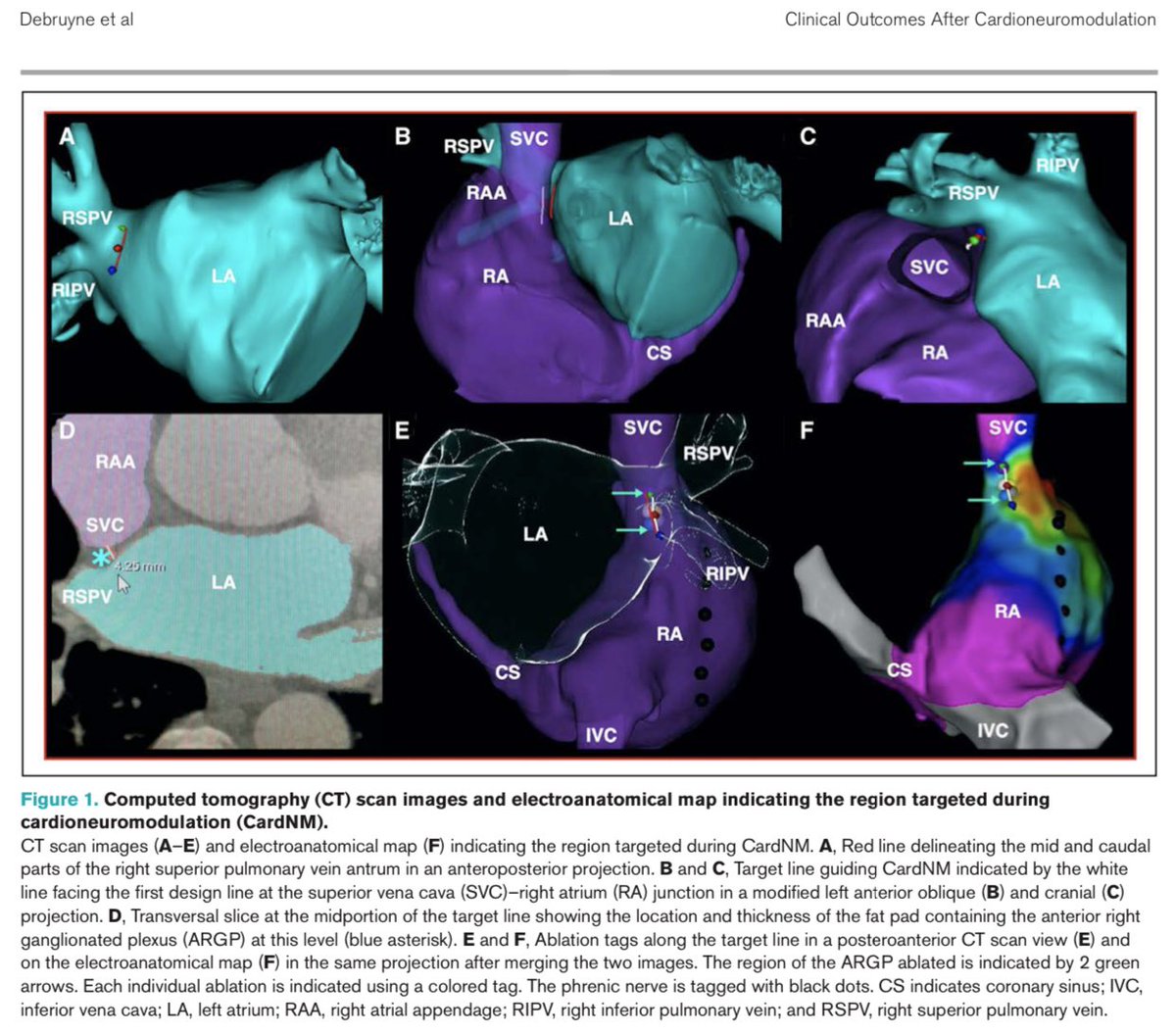 ShaojieChen1's tweet photo. Cardioneuromodulation: Physiological Changes and Decreased Syncope Burden 12 Months After Unifocal Right- Sided Ablation Under Computed Tomographic Guidance in Patients With Neurally Mediated Syncope or Functional Sinus Node Dysfunction, from Debruyne et al., #circep #EPeeps https://t.co/EQYmpZXiv0