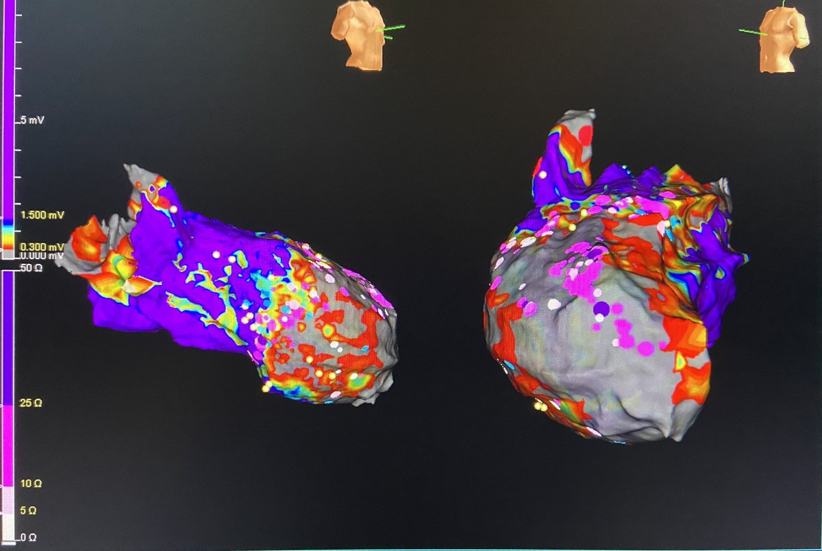 texasEPkait's tweet photo. Scar at the apex with frac and LPs at the border zone in this ischemic VT. Positioning our catheter along this zone prior to induction quickly led us to a channel along the anterior scar border! Check out the MidD sigs! Mapped by @PraveenRao_EP #ablatevt #epeeps @AbbottCardio https://t.co/crHTWZmc40