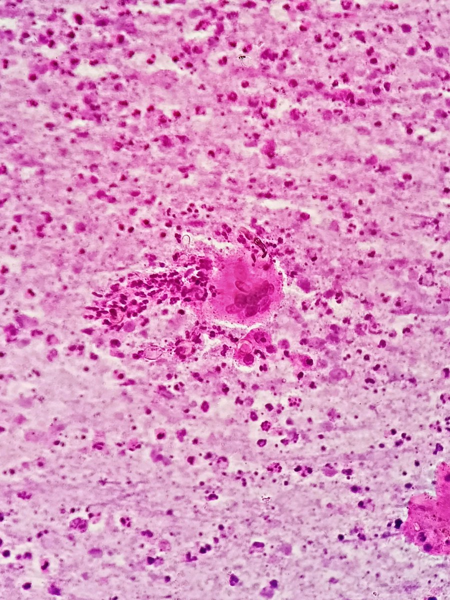 megha_lalcheta's tweet image. Middle aged | Farmer | Ankle swelling Fna

#PathTwitter #FNApath