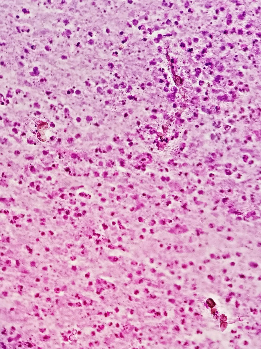 megha_lalcheta's tweet image. Middle aged | Farmer | Ankle swelling Fna

#PathTwitter #FNApath
