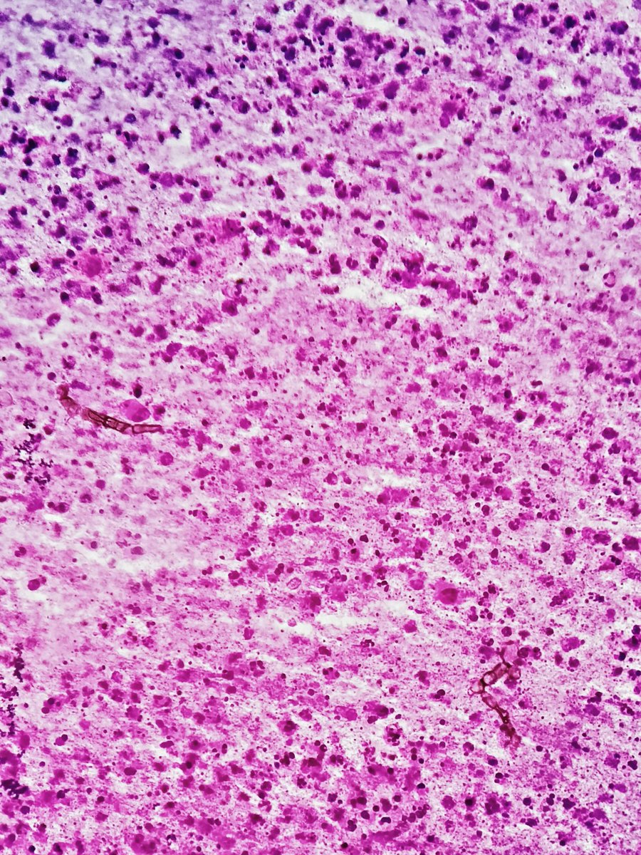 megha_lalcheta's tweet image. Middle aged | Farmer | Ankle swelling Fna

#PathTwitter #FNApath