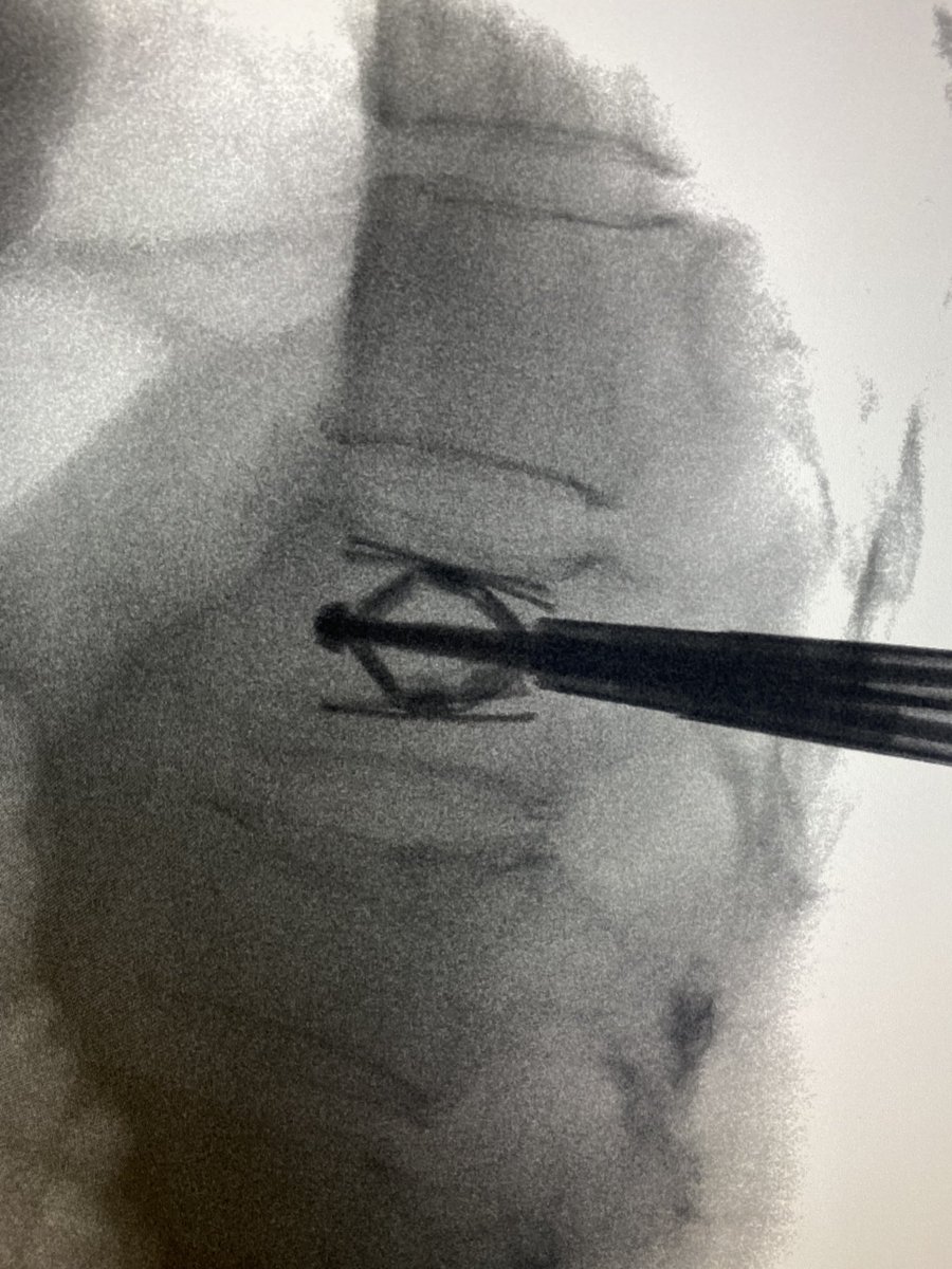 CU MSK Radiology (@cu_msk) on Twitter photo Excellent height restoration and #spinejack placement by finishing fellow <a href="/James_Korf/">James Korf</a>. Must be ready for facultyhood. #vertebralaugmentation <a href="/stryker_spine/">Stryker Spine</a> <a href="/CURadiology/">CU Radiology</a> Excellent height restoration and #spinejack placement by finishing fellow <a href="/James_Korf/">James Korf</a>. Must be ready for facultyhood. #vertebralaugmentation <a href="/stryker_spine/">Stryker Spine</a> <a href="/CURadiology/">CU Radiology</a>