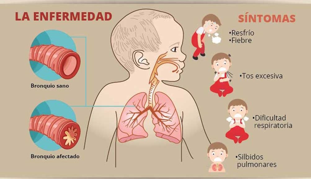 Llegó el invierno y con el las Bronquiolitis, vamos a repasar los mecanismos de insuficiencia respiratoria en esta patología: