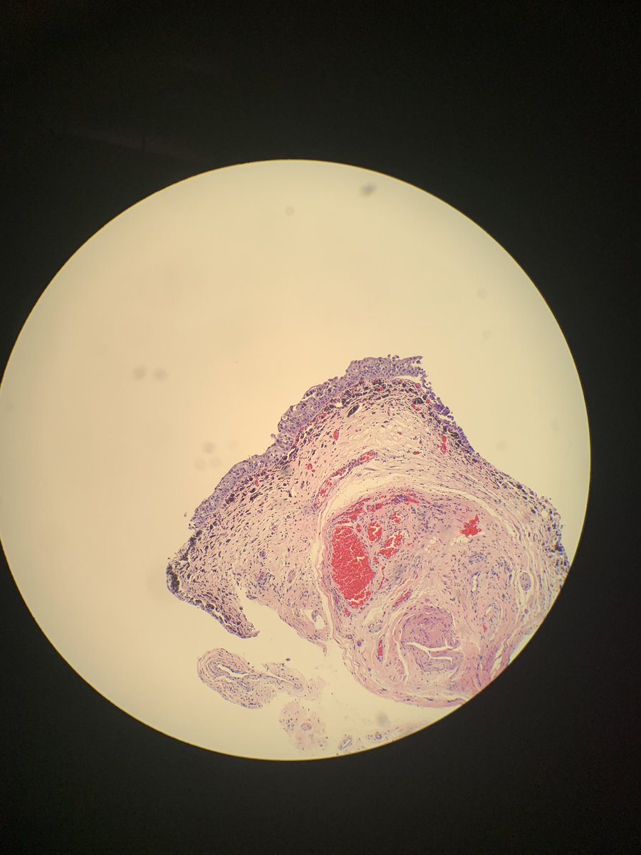 RFutoran's tweet photo. Bladder bx of dark spots.  Iron stain is neg. #pathology #GUpath  never seen this before this week so had to share.  Just curious who’s seen this before? https://t.co/Xs7wfxLRfl