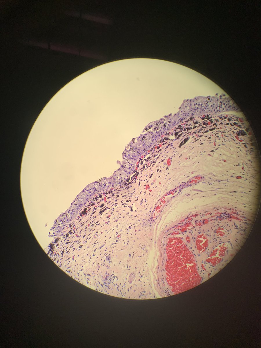 RFutoran's tweet photo. Bladder bx of dark spots.  Iron stain is neg. #pathology #GUpath  never seen this before this week so had to share.  Just curious who’s seen this before? https://t.co/Xs7wfxLRfl