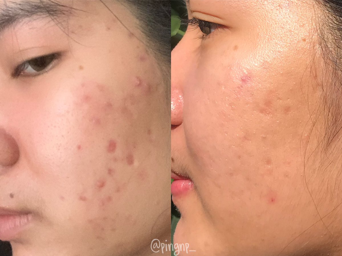 pingnp_'s tweet image. เห็นป้ายยาครีมซอง #Skinsista มาเยอะมาก จนต้องลองซื้อมาใช้ เนื้อเจลจะมีกลิ่นหอมอ่อนๆ🍋 เอาจริง!ใช้แล้วคือรู้สึกหน้าใสขึ้นตั้งแต่อาทิตย์แรกเลยอะ รอยสิวยุบลงไปเยอะด้วย หาซื้อง่ายตามเซเว่น ใครอยากลองต้องรีบซื้อน้า #SSHonestReview #รีวิวหน้าหมองคล้ำ #SSHonestReview #รีวิวหน้าหมองคล้ำ