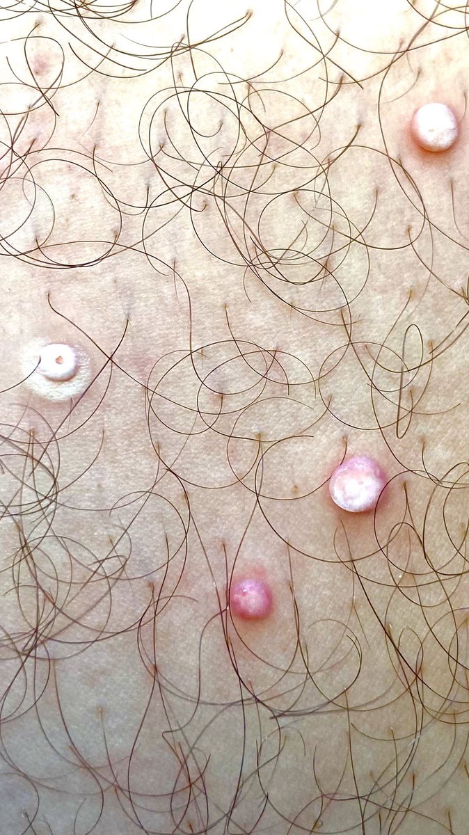 AndamoyoAlberto's tweet photo. No toda lesión en área genital es condiloma. Otra ITS frecuente es el molusco contagioso, al aplicar crioterapia adquiere un característico ombligo. #dermatologia #ITS #medicina #consulta #dermatology https://t.co/mmcdofgf5A
