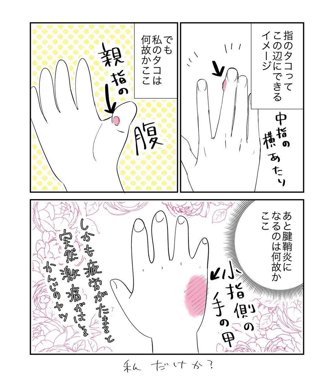 みんなのペンダコ・腱鞘炎はどこにあるの? 