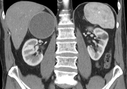 Is time for an interesting adrenal case!! Middle aged man with history of melanoma
🟡 What is your diagnosis?
🟢 What would you recommend?