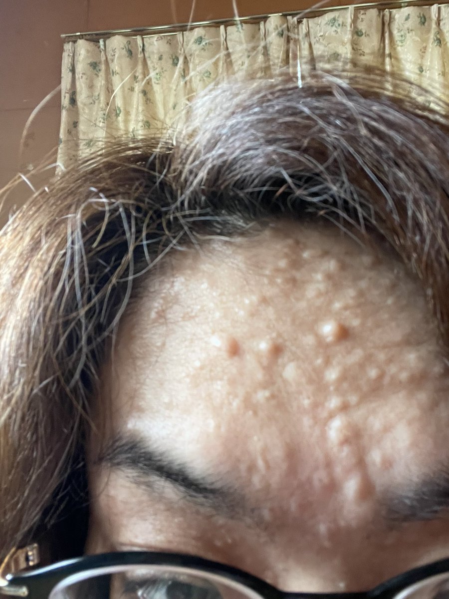 神経線維腫 Twitter Search Twitter