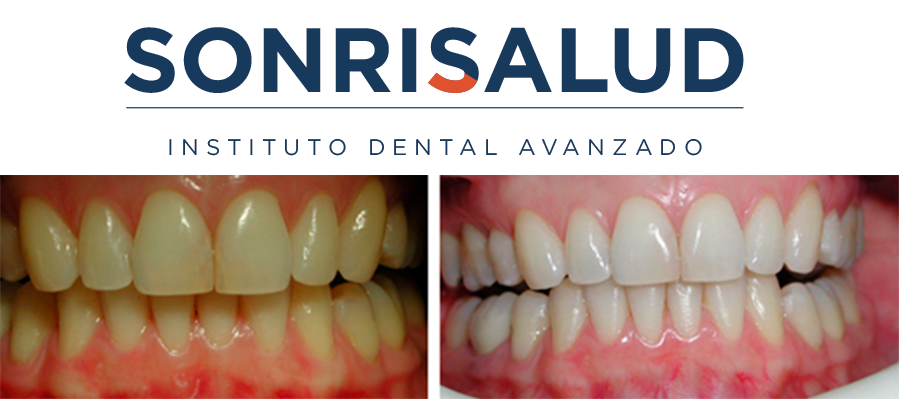 sonrisalud_es's tweet photo. ¡El blanqueamiento dental, el tratamiento estrella del verano!
https://t.co/gzWhVtuXEY https://t.co/DgwZge4VkM