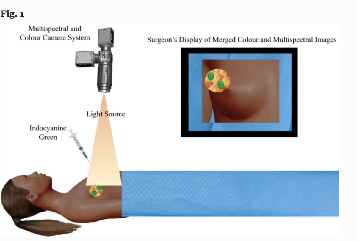 JULY ISSUE: Meta-analysis Comparing #FluorescenceImaging with Radioisotope and Blue Dye-Guided #SentinelNodeIdentification for #BreastCancerSurgery. ow.ly/k8dC50FpivU @McMastersKelly @SocSurgOnc