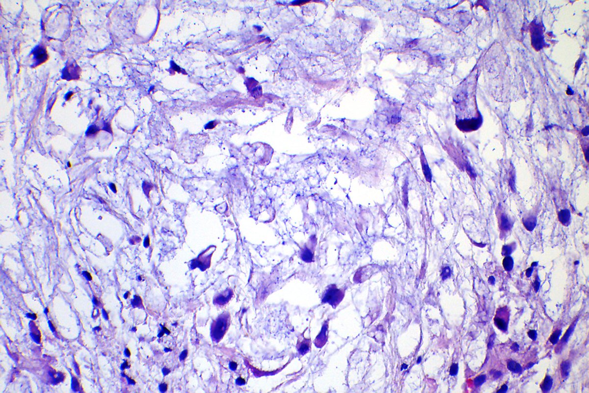 Elena_PradosMD's tweet photo. SUPERFICIAL ANGIOMYXOMA (CUTANEOUS MYXOMA)
🩺 42 yo M with cutaneous cystic lesion
🚩 right arm
🕒 3 months evolution
🔬angiomyxoid nodules (vessels, bland spindled cells, myxoid stroma)
🎈CD34, S100, SOX10, actin negativity
@JMGardnerMD #bstpath #dermpath #pathsurvivalguide https://t.co/rvE6wB9IeX