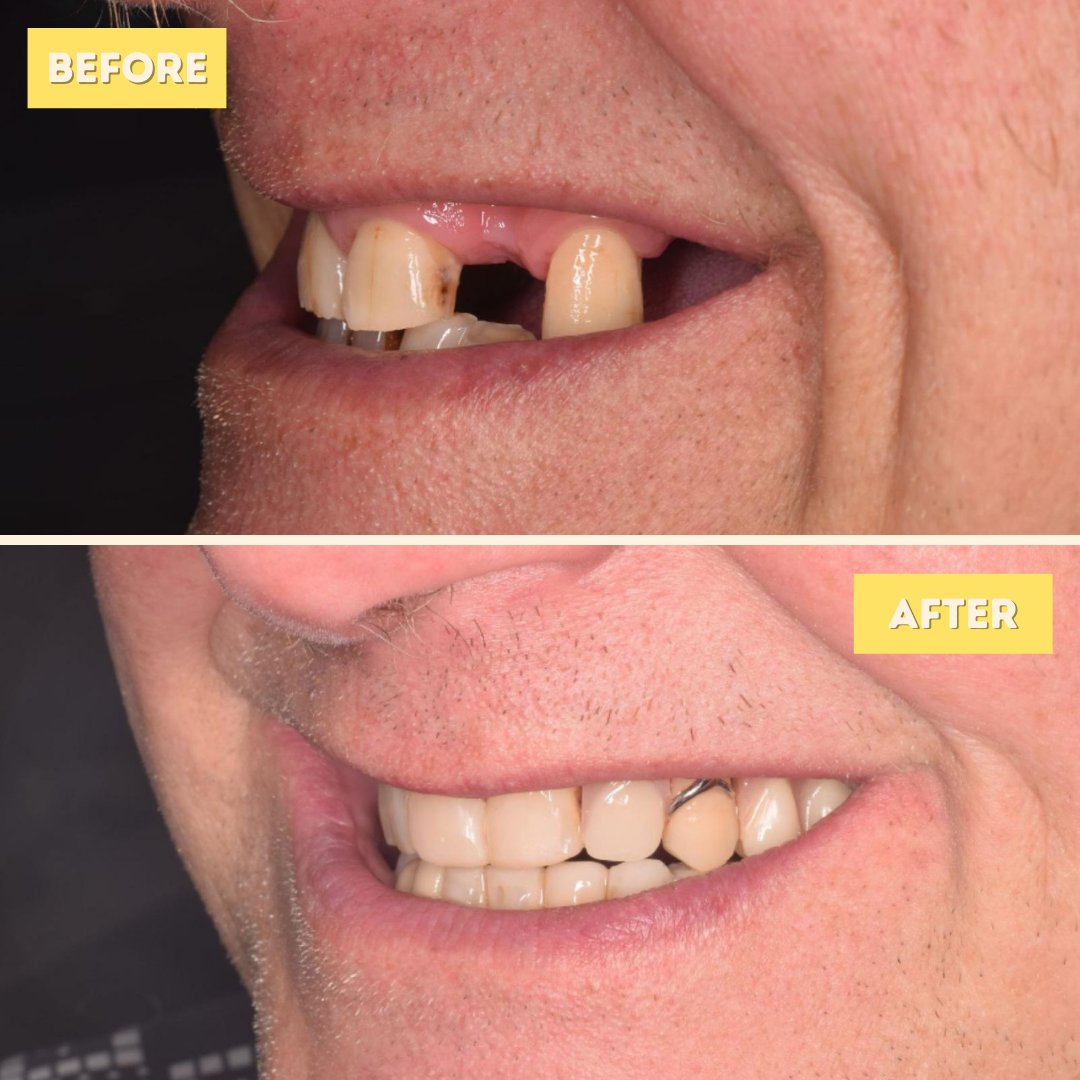 If you are looking to change your smile but don't know where to start, why not book a Free Consultation?🧐

During this, we can discuss your smile, what you want to achieve and how we can help you!🥰💛

To book, click here: standrewsdentalcare.co.uk/request-a-free…

#dentist #standrews #fife