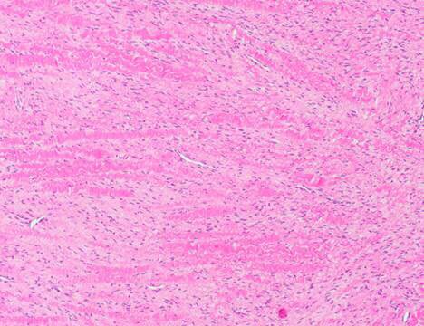 MelanieBoisMD's tweet photo. #HEARTThursday is a day late this week, but still a great source of  #cardiacpath #cvpath learning.

Answer via the poll below! A discussion will be posted on the @MayoClinicPath handle next Tuesday. https://t.co/m7Lwg9A4g3
