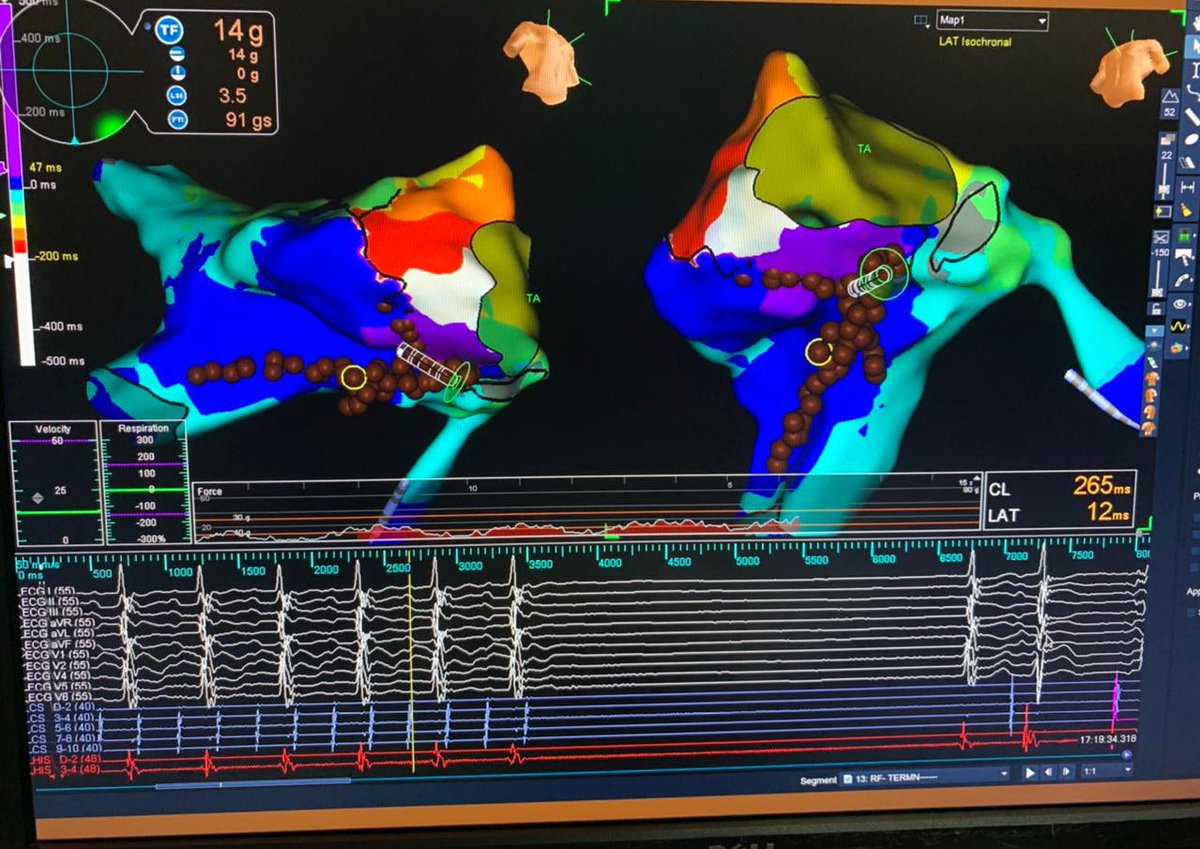 Dr.Jayapandian P (@jayapan59971280) on Twitter photo Post surgical ASD closure,dilated RA chronic AFL- dual loop / ?single loop with collision / entrained in both loops with ppi-tcl <20 ms,,mapped with HD grid,reaching /stability at annular site with contact was challenge,used Agilis with contact force <a href="/sabarisarav/">sabari saravanan</a> Post surgical ASD closure,dilated RA chronic AFL- dual loop / ?single loop with collision / entrained in both loops with ppi-tcl <20 ms,,mapped with HD grid,reaching /stability at annular site with contact was challenge,used Agilis with contact force <a href="/sabarisarav/">sabari saravanan</a>
