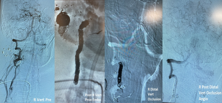 PenNeuro's tweet photo. US HCPs: Fistulas + trauma to arteries coiled by @StrokeVAN at Banner Desert. Dr. Teleb, thank you for sharing!#PC400 #POD400
Rx only. For indications, contraindications, warnings, precautions &amp; potential adverse events see https://t.co/iWWO7Bfk2R Clinical results may vary https://t.co/8GOfBH0RMV
