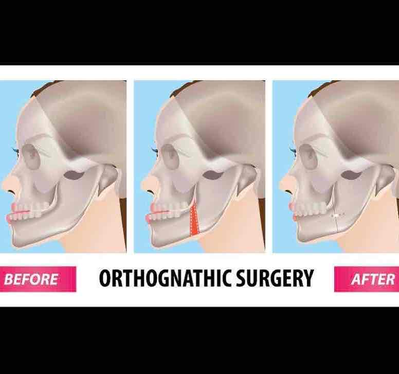 🔸 Cirugía maxofacial 🔸

El prognatismo mandibular se asocia a una oclusión dental clase III, y con distintos patrones faciales. 

#clinicabirbe #ortognatica #maxilofacial #ortodoncia #cirugía #estéticafacial #consultaonline #ortofacial #barcelona #birbe