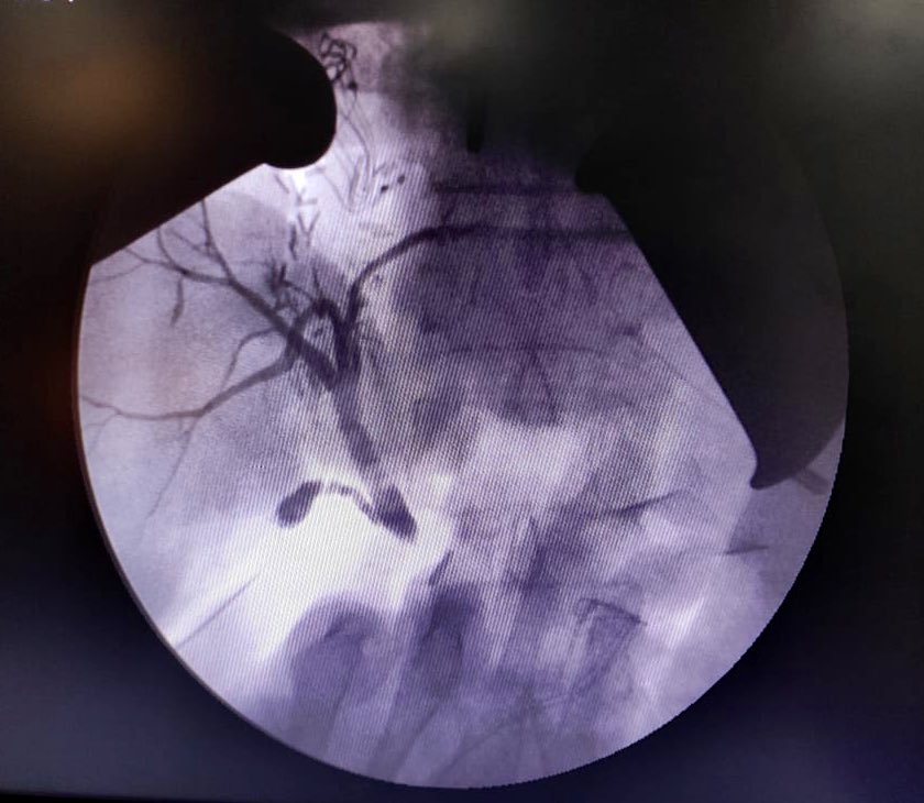 Did this cholangiogram during a left hepatectomy for an Intrahepatic Cholangiocarcinoma. What do you think is the significance? WWYD?  @IHPBA @hpb_so @hpbjournal #Liversurgery #surgtwitter #medtwitter