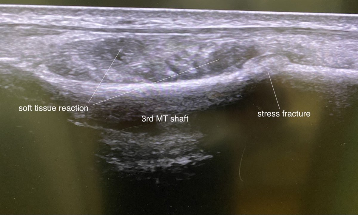 DrJN_SportsMed's tweet photo. Nice example of POCUS role. Elite tennis player with ⬆️ pain dorsal mid foot on loading &amp; local swelling. image (3rd met) shows loss of cortical definition &amp; periosteal reaction /elevation, adjacent dorsal soft tissue inflammation also involving digital extensor tendons.
Stress # https://t.co/ljmuOaANfT
