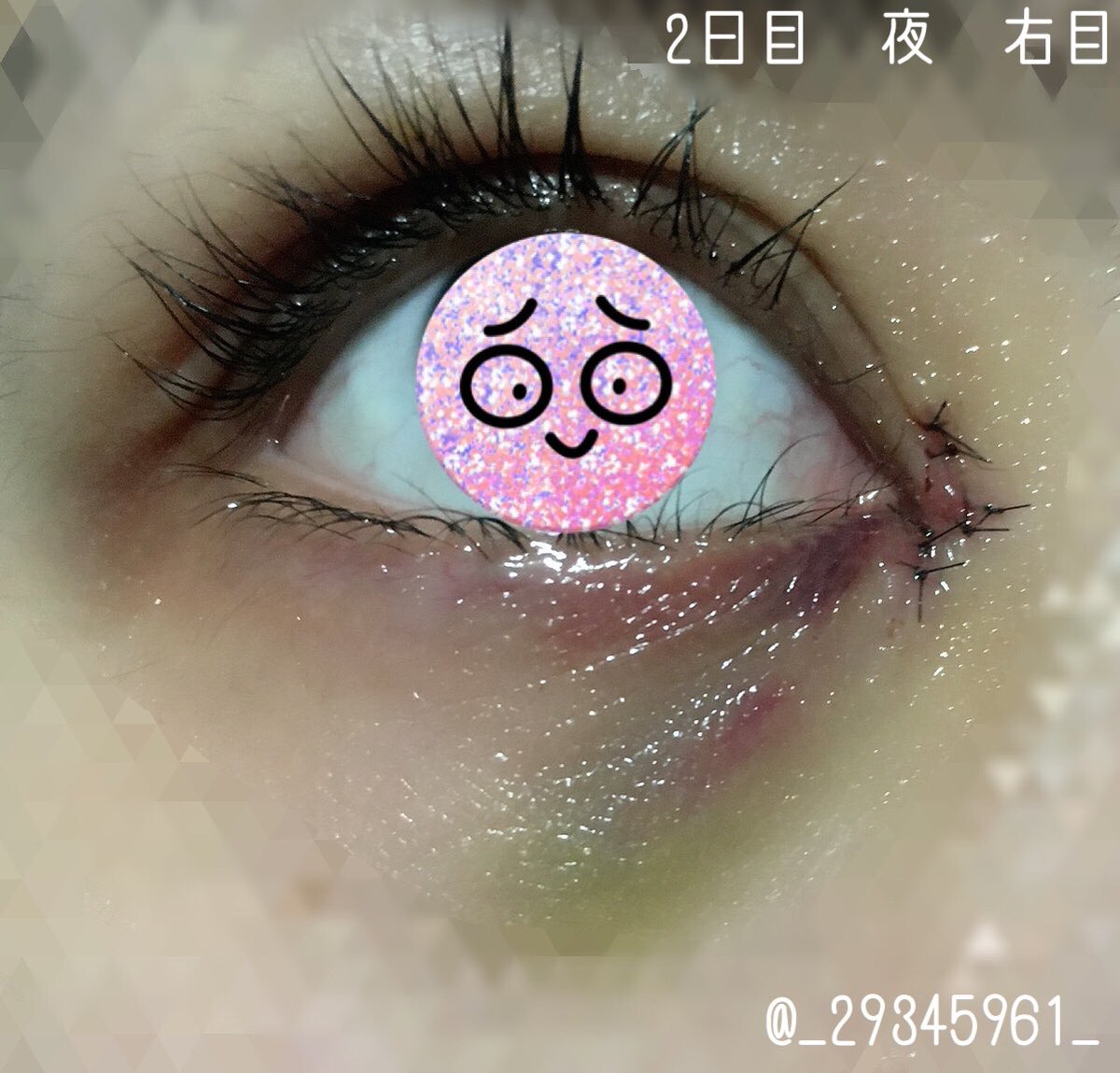 Hashtag 目頭切開 No Twitter Hashtag 目頭切開 No Twitter