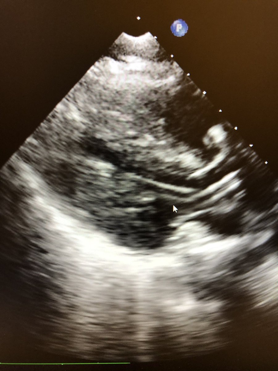 RajTayalMD's tweet photo. Witnessed out of hospital cardiac arrest. EF 10% by #POCUS, hypoxic on FiO2 100. V-A ECMO with antegrade distal perfusion and #ImpellaCP placed at bedside WITHOUT Fluoro using only #echofirst guidance for placement. Our team is strong and ready for the #waronshock @ValleyHospital https://t.co/c8grvX3x6y