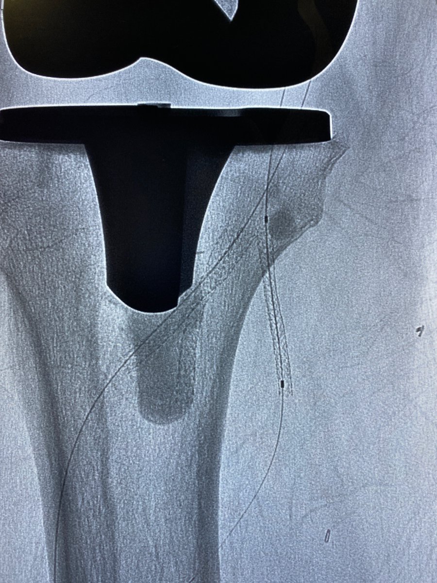 ramposham's tweet photo. Oh hey PGY 5! Passed the IR/DR Core Exam ✅ 3x MAA, UAE #justglueit, UFE #embozene, and Bypass/Tibial recan as first assist with @DieHCCDie @RSP516 and @vivianbishay @MountSinaiIR. Incredible start to the new academic year! Happy July! @SIRspecialists @SIRRFS https://t.co/kRzSnKrPG4