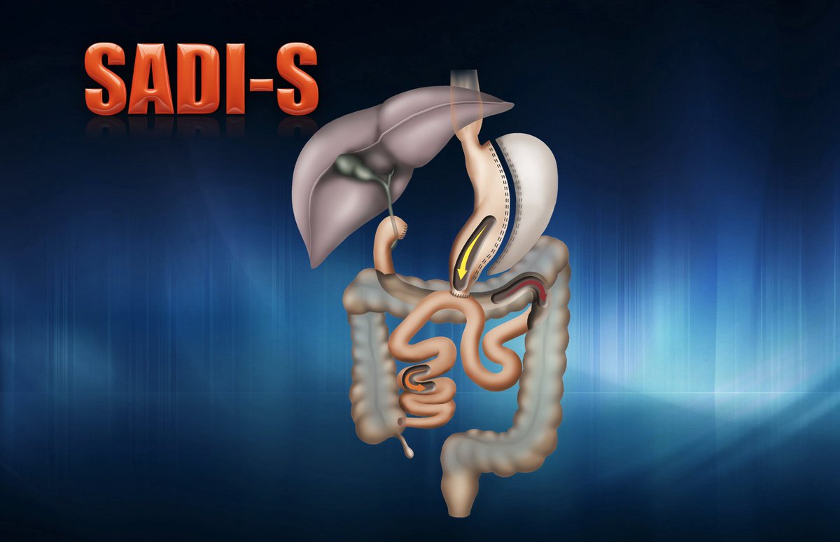 PSchauerMD's tweet image. SADI,READY FOR PRIME TIME? by @AntonioTorres63 AUG 5, 10 AM EDT. Sneak Peak youtu.be/GHQd__7l8BY Register pbgrandounds.org  @IfsoSecretariat @ASMBS @IBCClub1 @IBCOxford @SAGES_Updates @BariatricNews @BariatricTimes @NeilFlochMD @Bariatric_doc @dralqahtani1 @mjamal110
