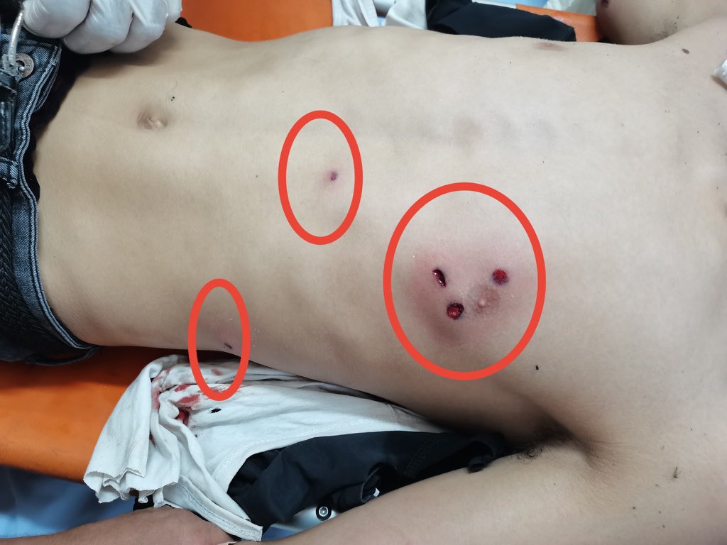 swilkinsonbc's tweet photo. Israeli occupiers shoot Palestinian child through his spleen causing shrapnel wounds to his waist as he protested israeli land theft in Beita https://t.co/SFCJiztmva