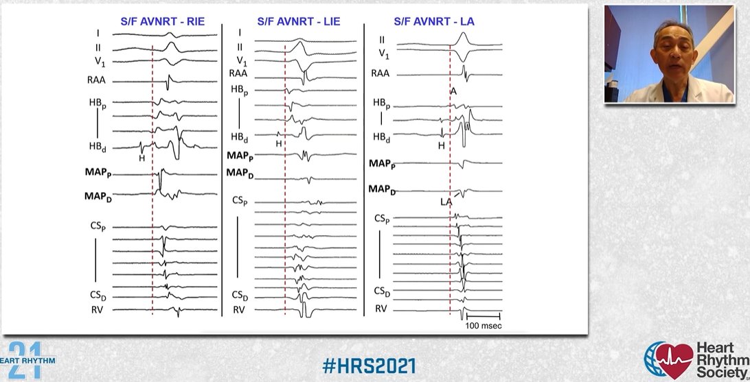 Sandeep Gautam (@gautamsand) on Twitter photo Carrying on #HRS2021 <a href="/HRSonline/">Heart Rhythm Society</a>
Masterful talk on 'SVT from Koch's Triangle' by Sunny Po!
*Clint Eastwood fandom
*There's more to ParaHisian pacing than you know
*Avoid 'Scorched Earth' ablation for AVNRT
*Recognize signs of leftward SP extension
bit.ly/3wwMuar Carrying on #HRS2021 <a href="/HRSonline/">Heart Rhythm Society</a>
Masterful talk on 'SVT from Koch's Triangle' by Sunny Po!
*Clint Eastwood fandom
*There's more to ParaHisian pacing than you know
*Avoid 'Scorched Earth' ablation for AVNRT
*Recognize signs of leftward SP extension
bit.ly/3wwMuar