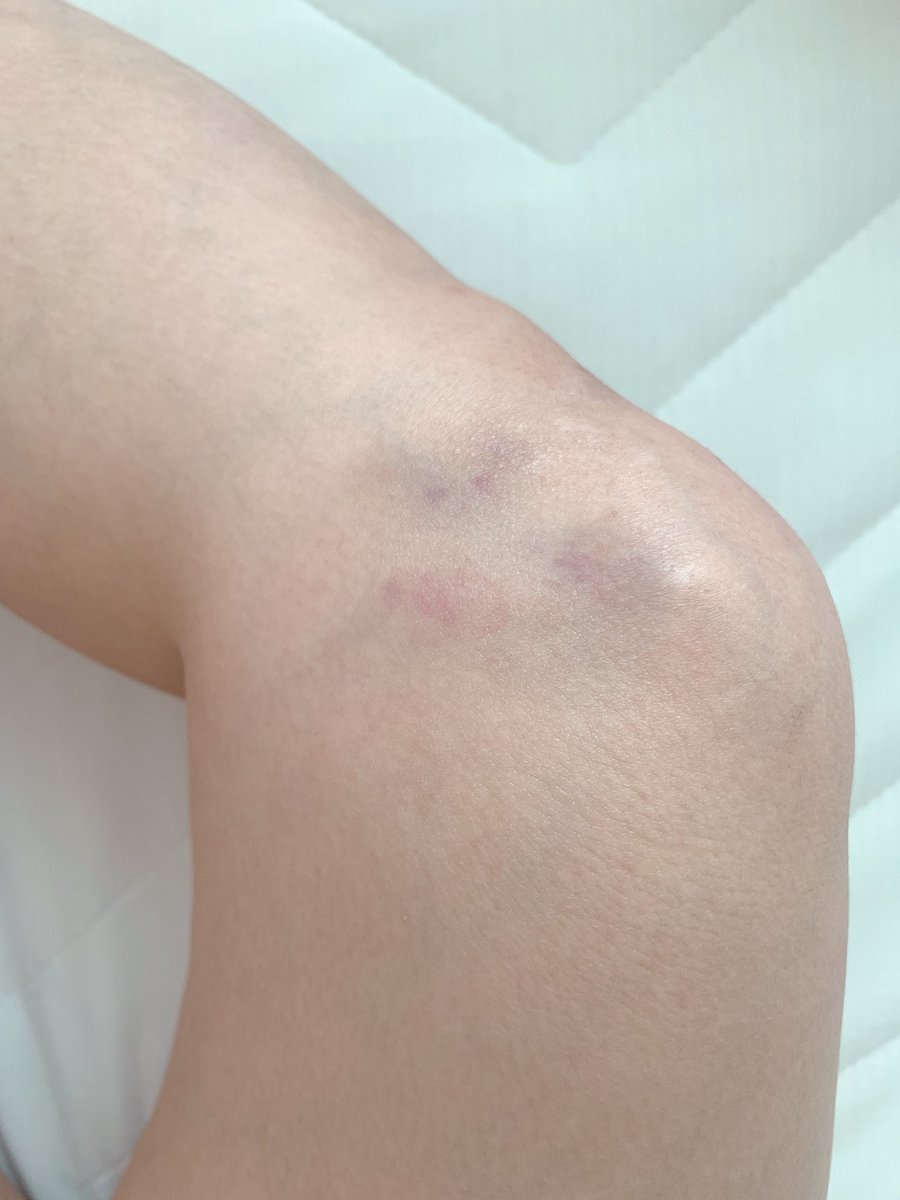 きみと歩実 紀見歩實 V Twitter 膝痛いなー って思ってたらアザめちゃ出来ててなんだろと考えた結果 昨日のイベントでやった 騎乗位ふうせん割り でやっちゃったやつでした ふうせん割れると同時に床に膝強打 真面目にやりすぎ自分 笑