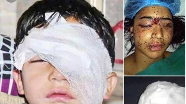 Manahyl_tk's tweet photo. The UN chief made observations of atrocity crimes against children in IOJK, in his latest report “Children &amp; Armed Conflict”. 
Children in #Kashmir are brutally injured with pellet guns and this disregard for children’s rights is heart wrenching. https://t.co/wlq1W9b3Hy