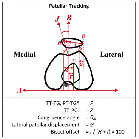 OJSM_SportsMed's tweet photo. Good to know! This meta-analysis from @RothmanOrtho showed that the TT-TG, TT-PCL &amp; PT-TG are reproducible measurements for patellar tracking &amp; the Insall-Salvati is reproducible for patellar height! #patellarinstability #patellardislocation https://t.co/f9yU8LO3EM https://t.co/MZ71rWj3O3