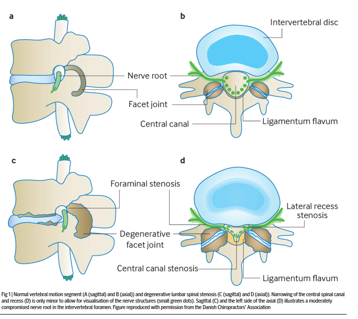PhysioMeScience's tweet photo. BMJ

Lumbar spinal stenosis

👀👀👇👇‼️‼️

https://t.co/2lB2AGyfD1 https://t.co/lJA5zBIKnU