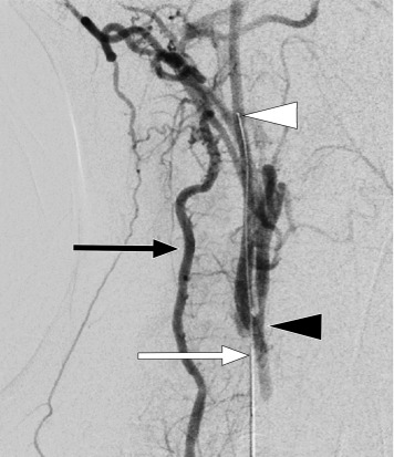 Direct Carotid Artery Puncture for Thrombectomy in Pediatric Stroke | ow.ly/L7Wj50EZ46o #irad
