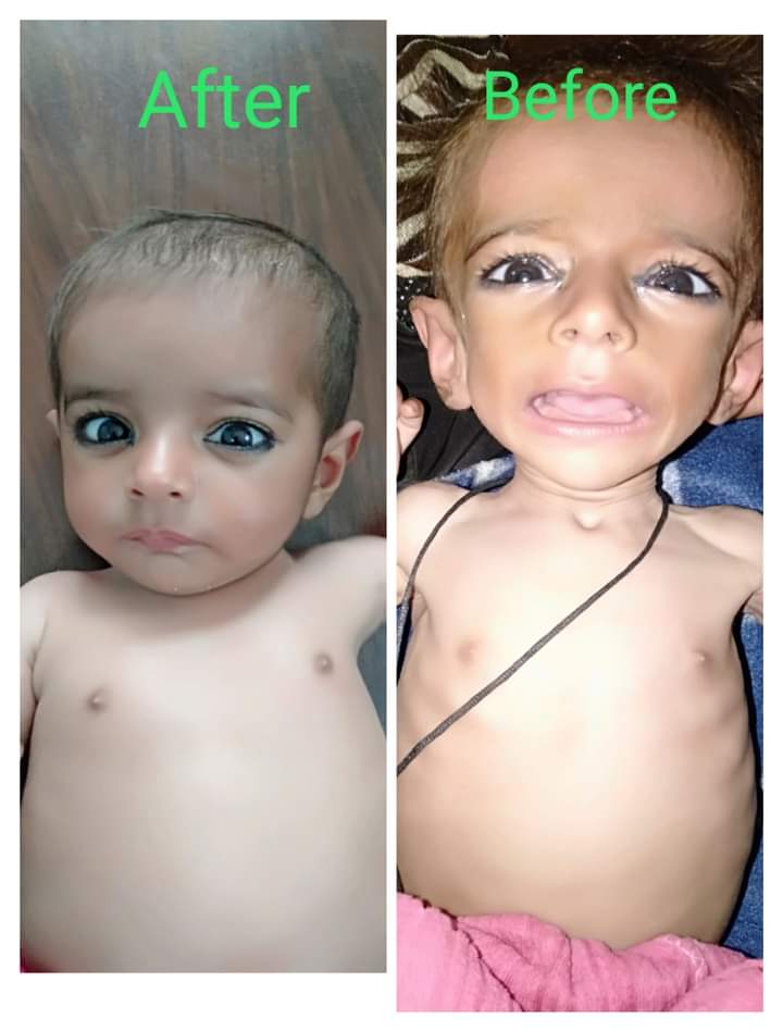 AmirShahzadNL's tweet photo. This 9 Months old Child has been cured from Severe Acute #Malnutrition with #Nutrition #therapy within 21 days at #THQ #Hospital #Chishtian.
#MalnutritionAwareness #SHNS
#Regularize_SHNS
#SchoolHealthPrograme
@PSPUPunjab @PSHDept @RajaBasharatLAW @DrNaveed9 @Dr_YasminRashid https://t.co/Kz9inVSaIf