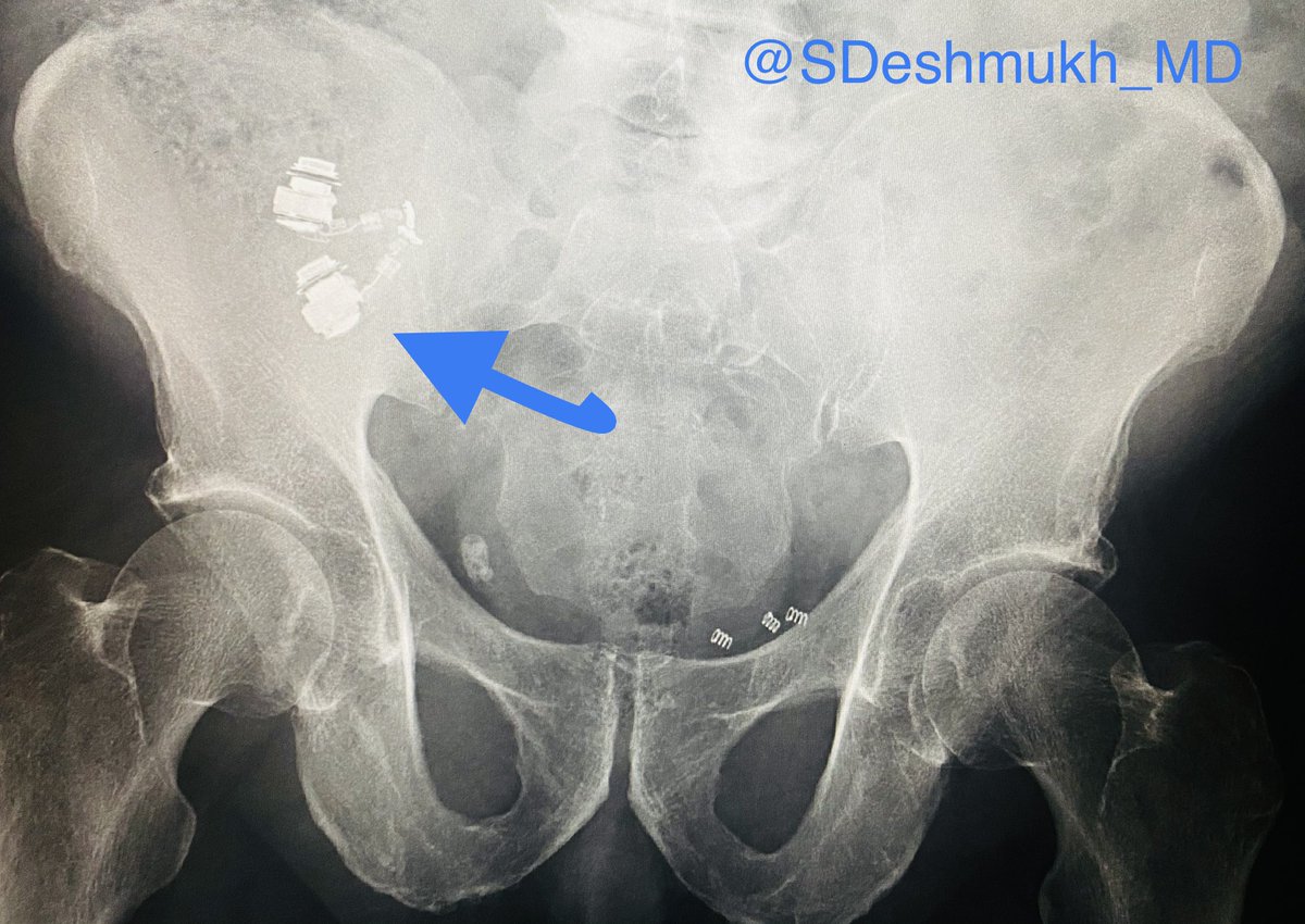 SDeshmukh_MD's tweet photo. Hot debate in the #radiology reading room: what brand of headphones was ingested? 🎧😳
.
#GIconsult @NinaNandyMD https://t.co/kFk9VlV8iX