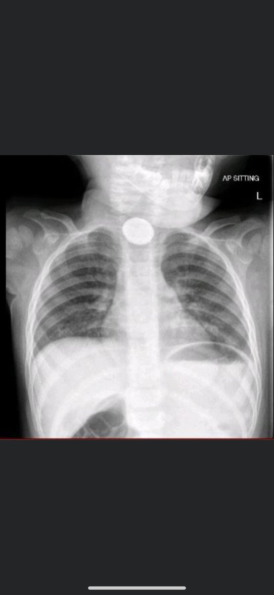 Button batteries are found in many item around the home, including hearing aids. As we saw tragically in the news yesterday, they can be deadly if swallowed by children. 

It's important to keep batteries out of the reach of children and keep them in their packaging until needed.