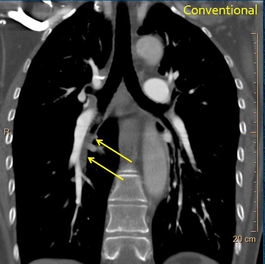 CtSpectral's tweet photo. Large perfusion defect in right lower lobe, without PE. 

This is reflex hypoxic pulmonary vasoconstriction from bronchial mucus plugging (arrows), as blood gets shunted to areas of the lung with better oxygenation.

Euler-Liljestrand mechanism! #SpectralCT #FOAMed https://t.co/8xp26whzoK