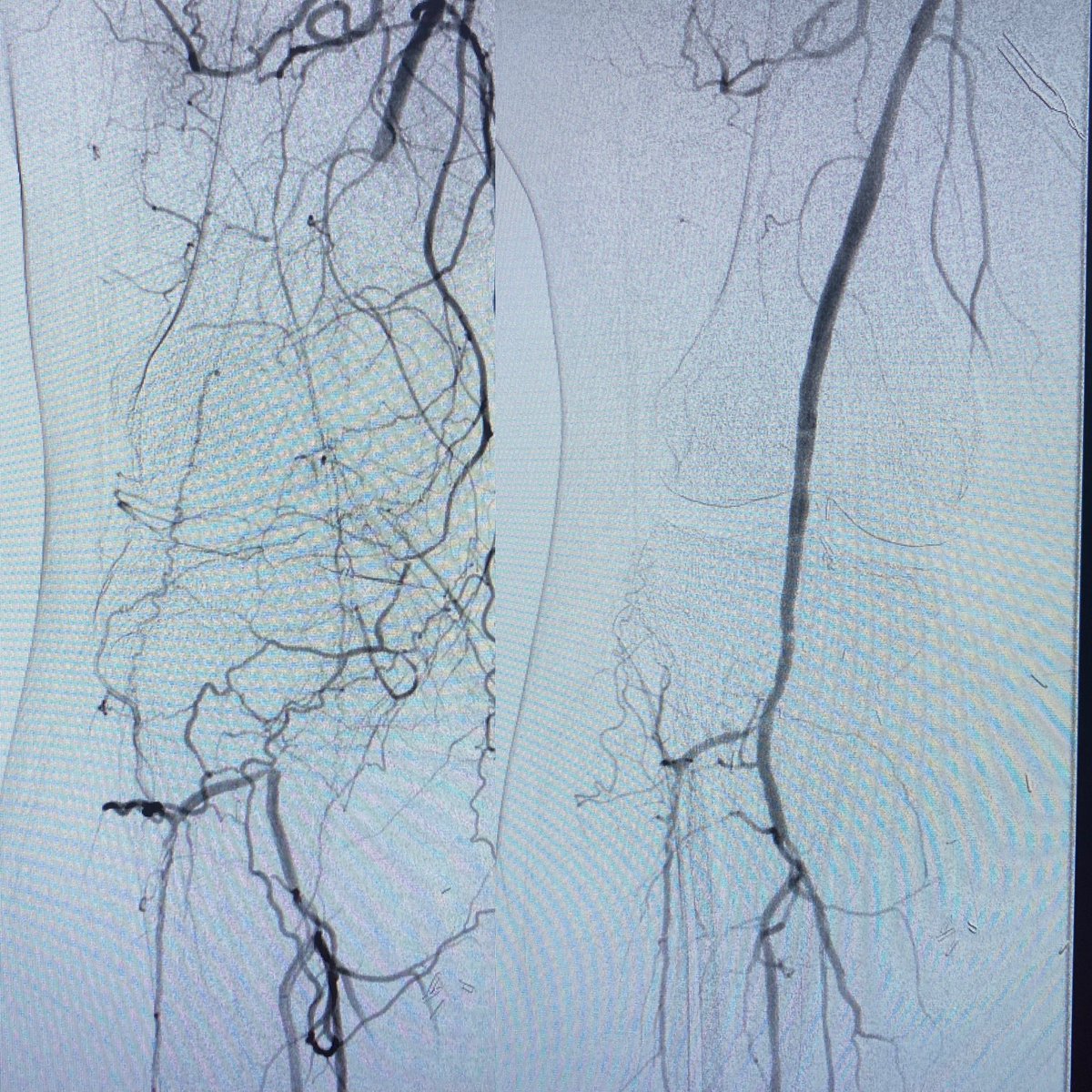 limbsalvagedr's tweet photo. theme of the day...#clotclotclot @PenVascular saved the day for these two cases! #someopensomeendo #fillyourtoolbox #comprehensivevascularcare #vasctwitter https://t.co/ulgeNkiH9o