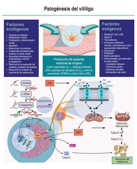 medigraphic_o's tweet photo. Pathogenesis of vitiligo. Autoimmune theory. 
https://t.co/K37NBarP5d

#Immunology #Vitiligo #Pathogenesis #OxidativeStress https://t.co/6GoBrgCmTR