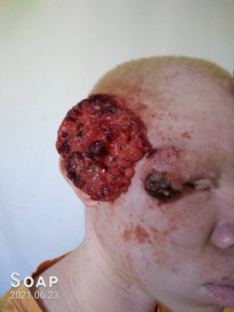 IKomayombi's tweet photo. La lutte continue!
Sentons nous concerner par ce combat contre le cancer chez les albinos.
Ils ont entre 18 et 21 ans.Pourquoi leurs vies devraient s’arrêter pendant que moi et vous pouvons faire quelque chose?
 Faisons quelque chose ensemble #touspareils @WalidNassor @hervemoj1 https://t.co/zrv4pcrr7h