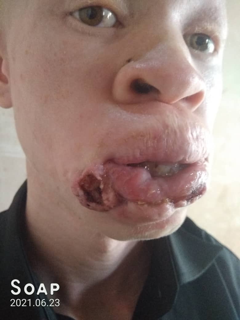 IKomayombi's tweet photo. La lutte continue!
Sentons nous concerner par ce combat contre le cancer chez les albinos.
Ils ont entre 18 et 21 ans.Pourquoi leurs vies devraient s’arrêter pendant que moi et vous pouvons faire quelque chose?
 Faisons quelque chose ensemble #touspareils @WalidNassor @hervemoj1 https://t.co/zrv4pcrr7h