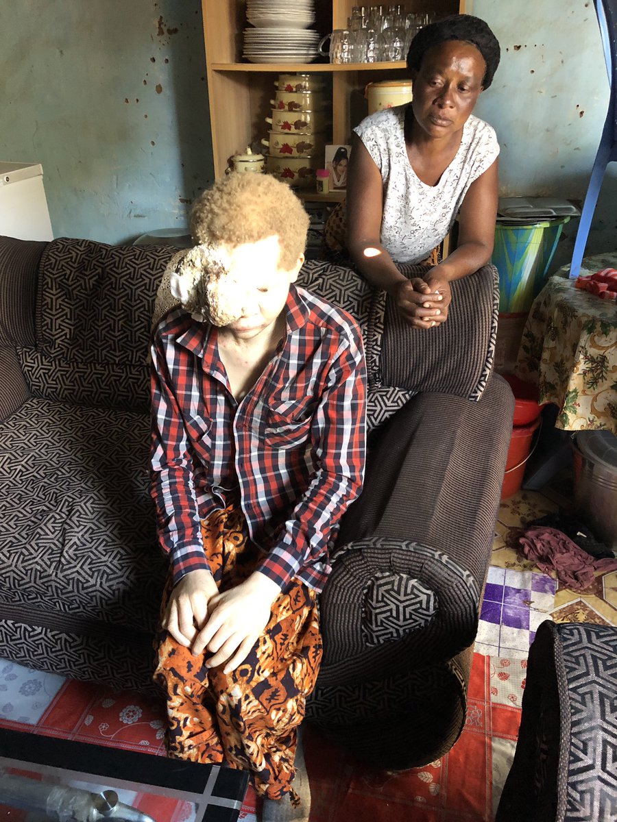 IKomayombi's tweet photo. La lutte continue!
Sentons nous concerner par ce combat contre le cancer chez les albinos.
Ils ont entre 18 et 21 ans.Pourquoi leurs vies devraient s’arrêter pendant que moi et vous pouvons faire quelque chose?
 Faisons quelque chose ensemble #touspareils @WalidNassor @hervemoj1 https://t.co/zrv4pcrr7h