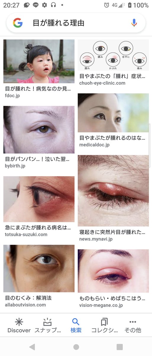 目が腫れる Twitter ख ज Twitter