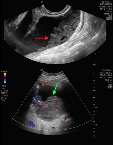 MathewLeonardi's tweet photo. Hey y'all #gyninfluencers
Have you heard about a decidualized #endometrioma?
To educate OBGYNs in North America (& abroad), @McMasterOBGYN just published on this unique entity in @AAGLJMIG - from diagnosis (using ultrasound - surprise surprise!) to mgmt!
https://t.co/e0d4RXS91F https://t.co/2s6TPMPtpt