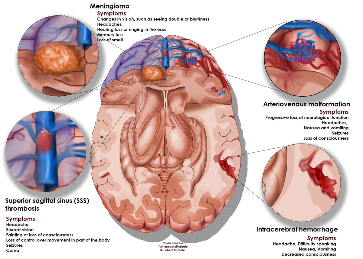 Excellent work by medical illustrator, medical student, and aspiring neurosurgeon Chidiebere Ibe. Check out his other work @ebereillustrate @FutureAfroNS @WFNSHQ #Neurosurgery